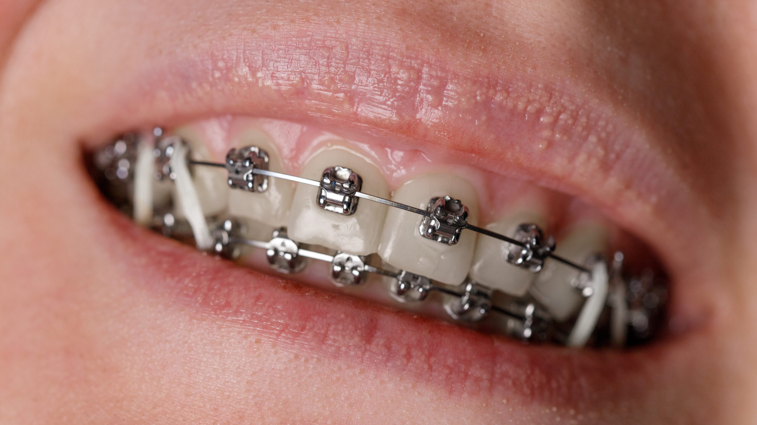 ¿Para qué sirven las gomas en los brackets?